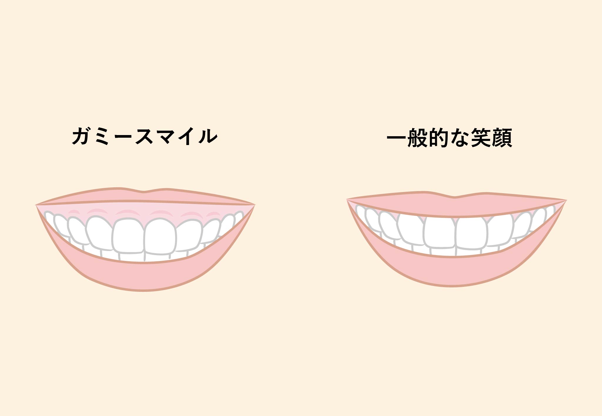 ガミースマイル