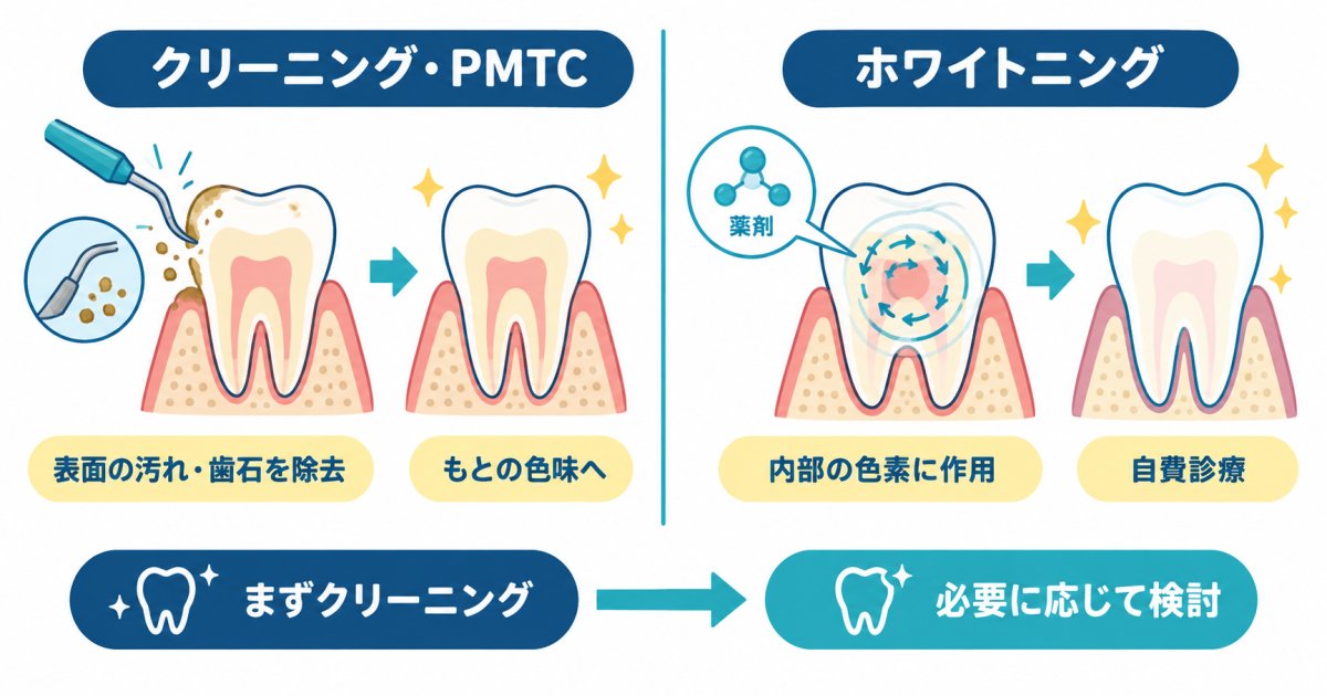 セルフケアの限界と歯科医院で行うプロフェッショナルケアの選択基準